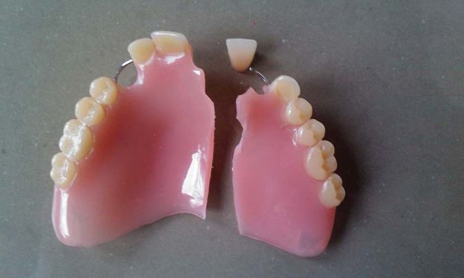 Dentier cassé - photo 2