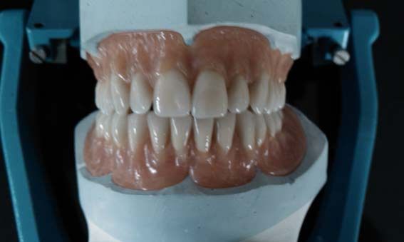 Dentier cassé - photo 3